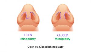 open rhinoplasty vs. close rhinoplasty 