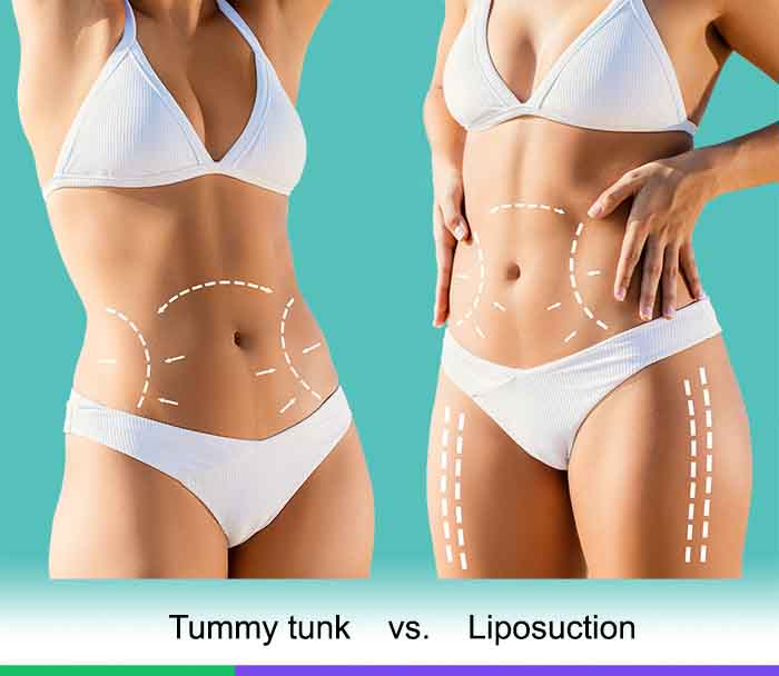 tummy tuck vs. liposuction 