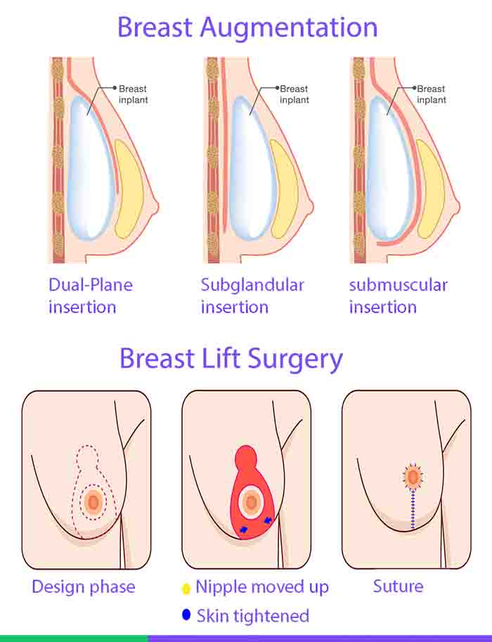 Breast Augmentation VS Breast Lift