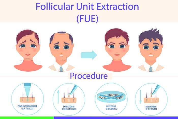 Follicular unit extraction (FUE) 