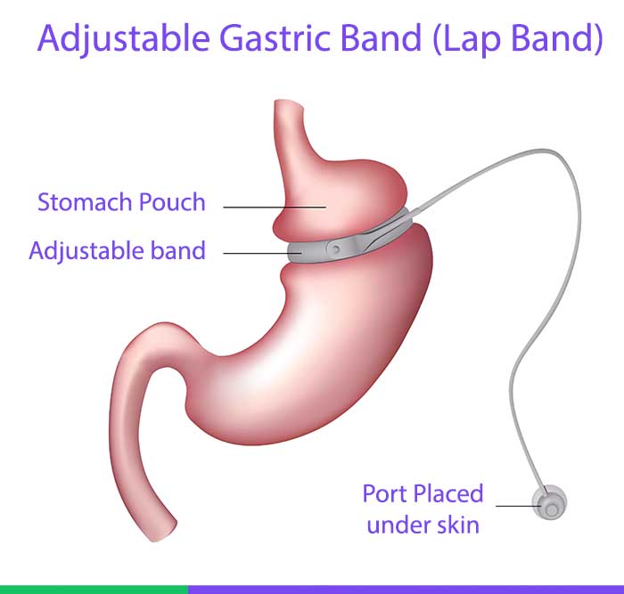 Gastric Band Weight Loss Surgery