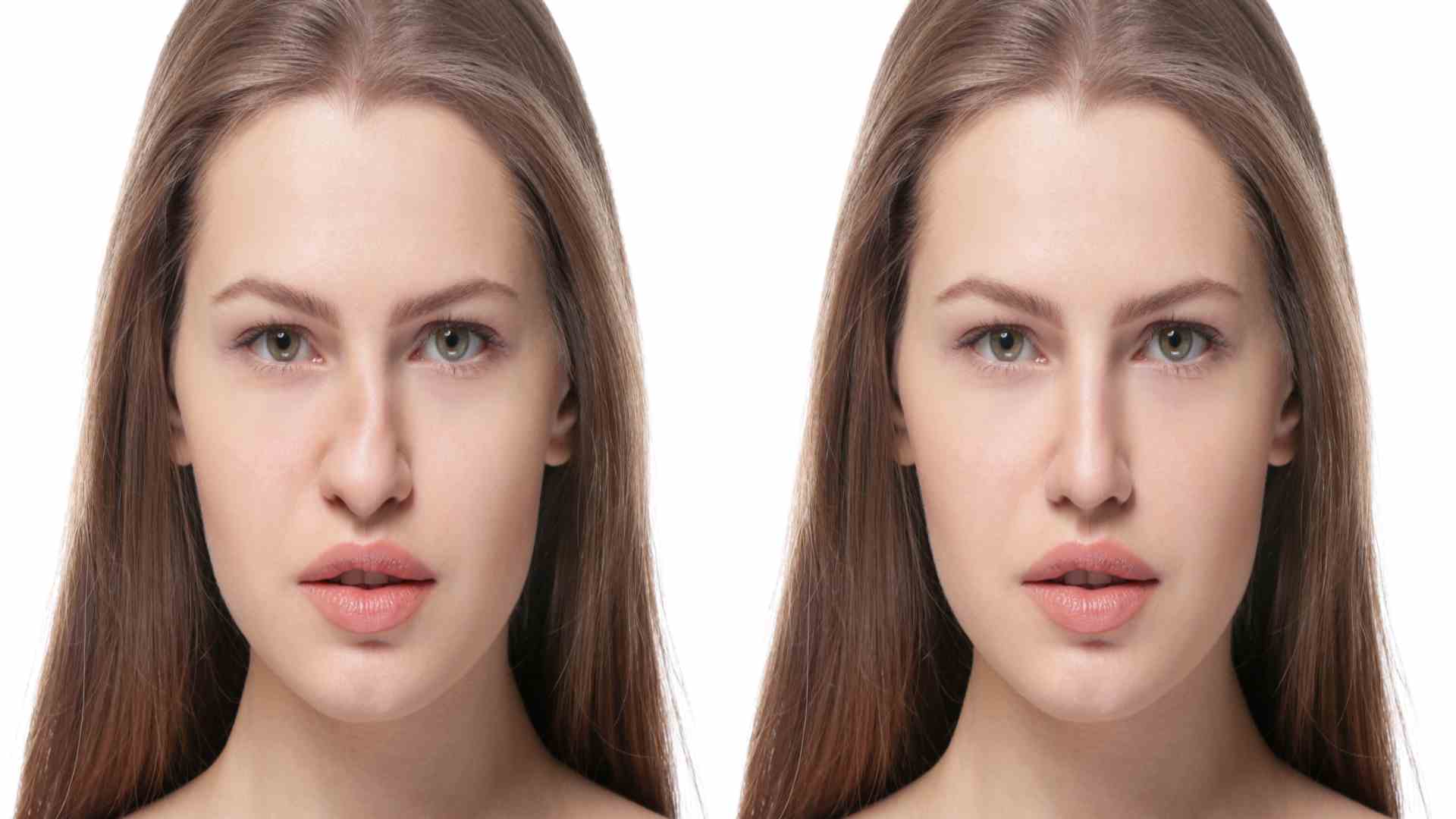 Everything You Should Know About Septorhinoplasty