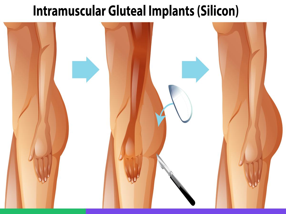 Types Butt Implant Surgery