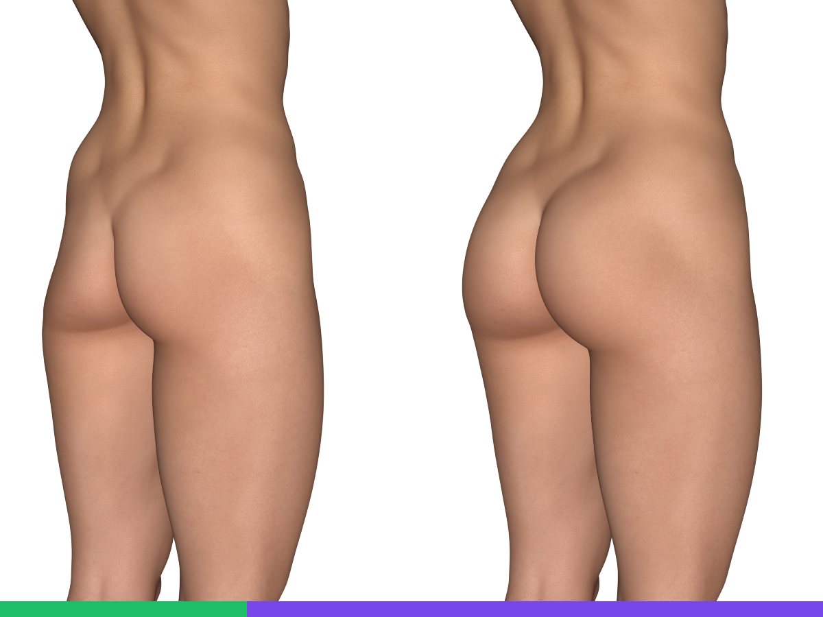 Why is a Butt Implant Surgery Done?
