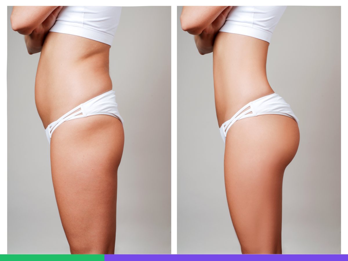 Why a Brazilian Butt Lift is done?
