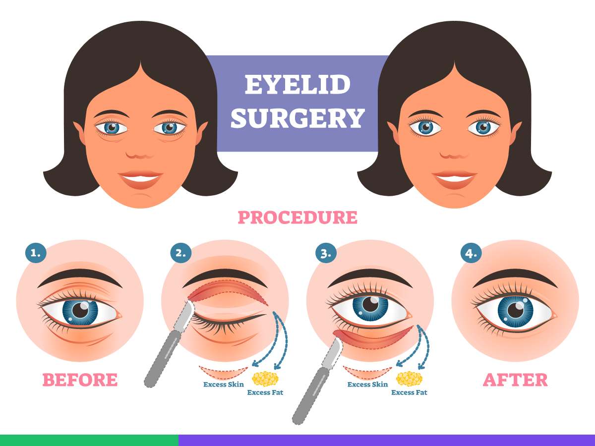 How is the Blepharoplasty Procedure Done?