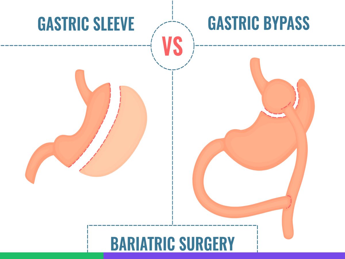 Gastric Sleeve vs. Gastric Bypass