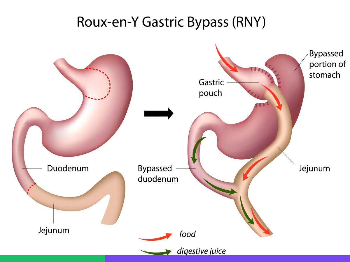 Roux-en-Y Gastric bypass