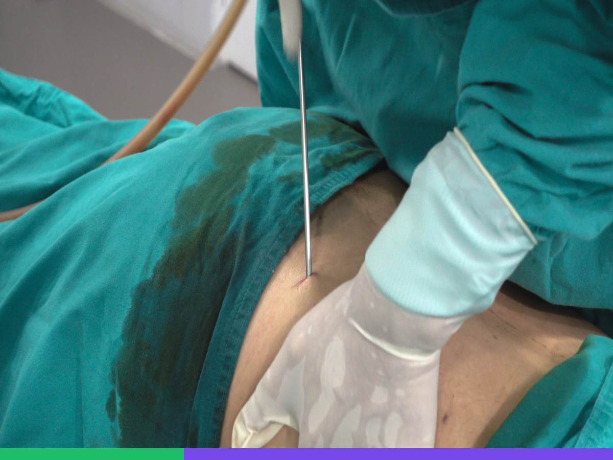 The Liposuction Surgery in Iran
