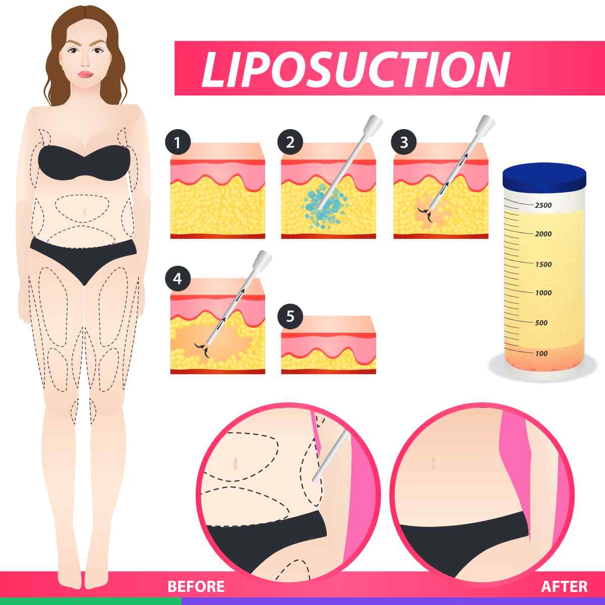 Liposuction Types and Techniques in Iran