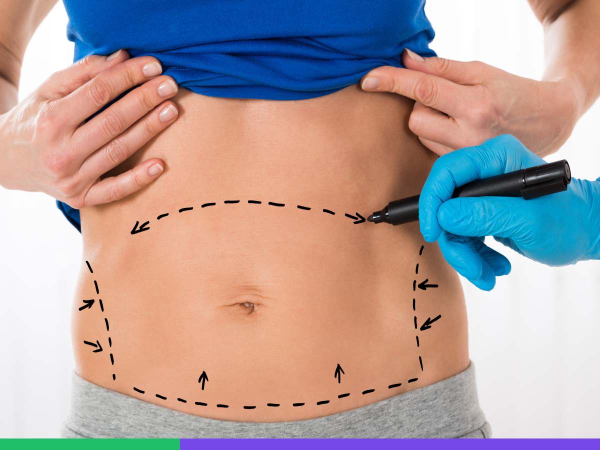 What are Tummy Tuck Types?