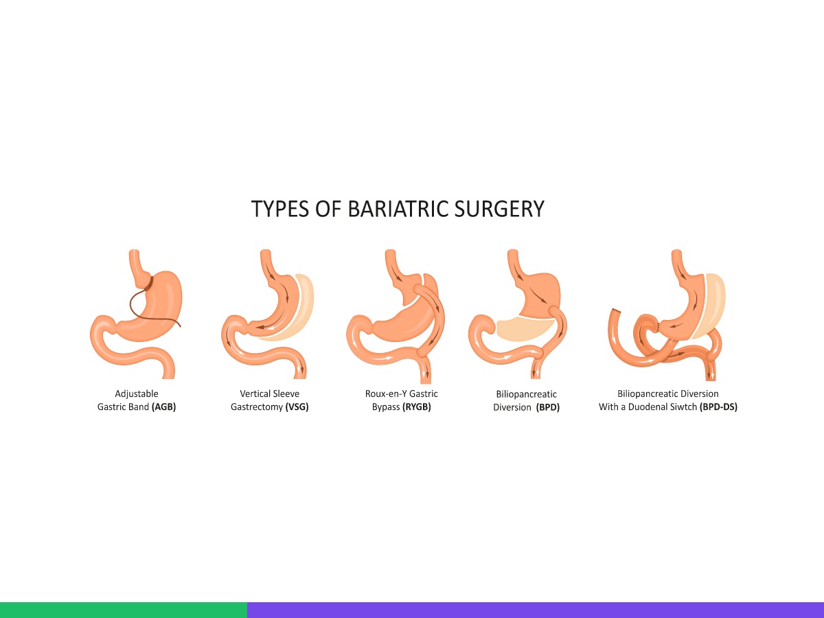 Types of Weight Loss Surgery